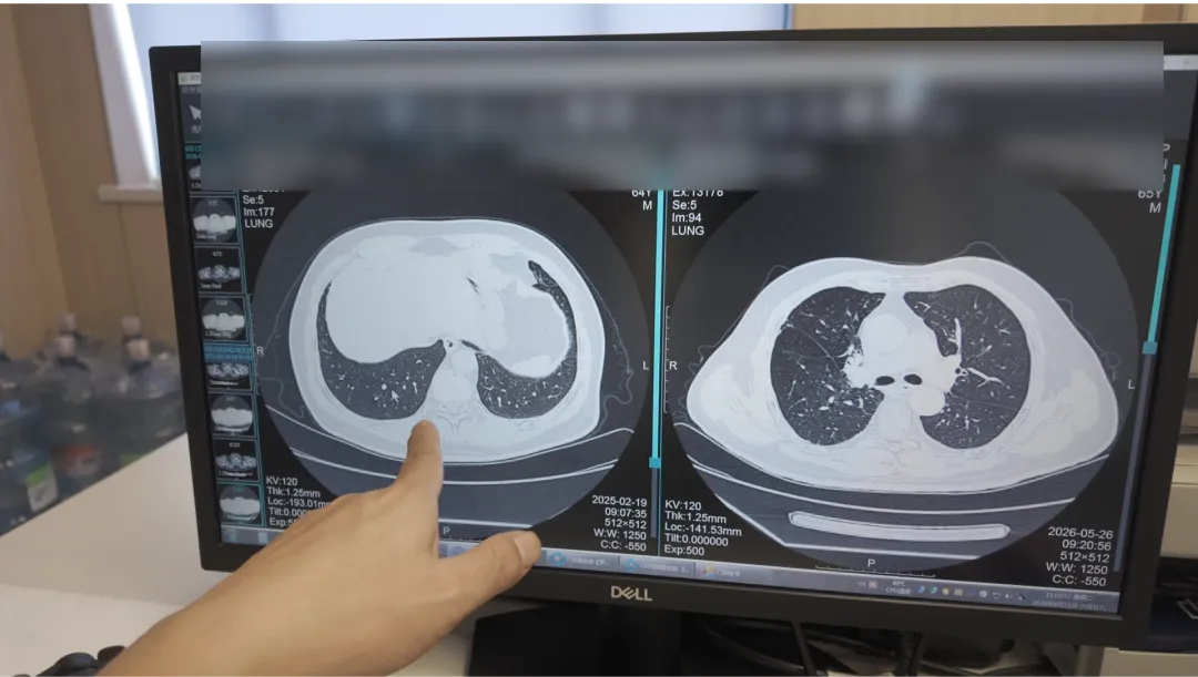 CT scans showing lung lesions before and after comprehensive treatment at Chongqing HYGEIA Hospital